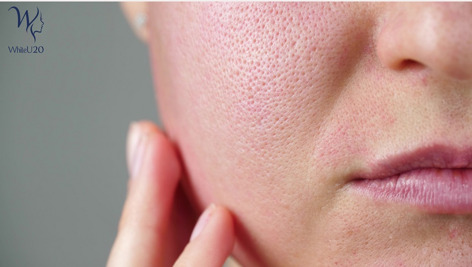 Với những người có làn da dầu, da nhờn thì rất hay gặp phải tình trạng lỗ chân lông to
